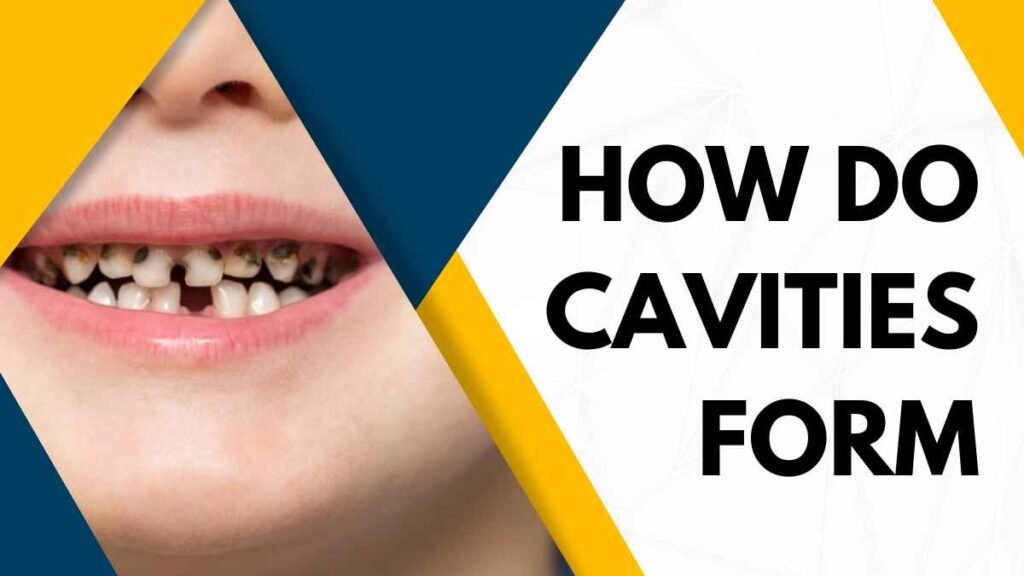 How Do Cavities Form