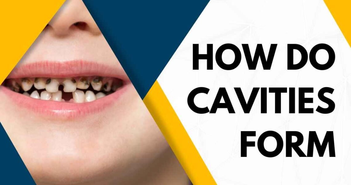 How Do Cavities Form